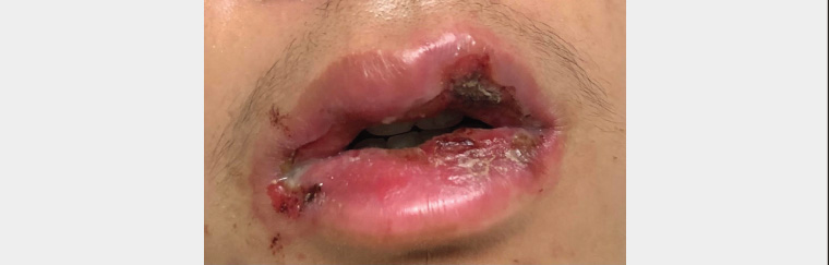 Figure 1. Crusting and ulceration of lips