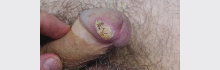 Figure 1. Patient with penile lesion