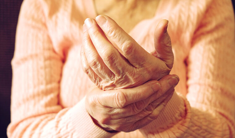 Woman with hand osteoarthritis