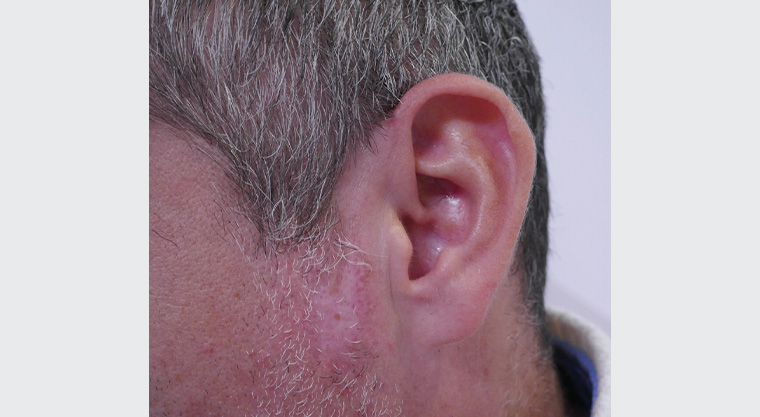 Figure 3. Resolution of lesion after topical corticosteroid therapy