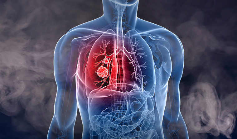 Graphic depicting lung cancer.