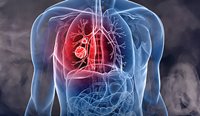 Stigma related to smoking and lung cancer can be a barrier to patients seeking timely diagnosis and treatment.