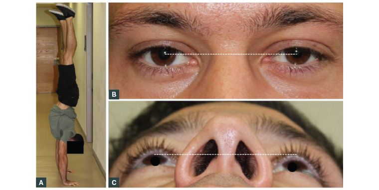 Figure 1. Clinical photographs taken of the patient at the first visit A. Patient in handstand position; B. Clinical photograph depicting subtle proptosis of the right eye; corneal reflex appears slightly lower from the upper eyelid when compared with the left eye (white line); C. Worm’s-eye view showing marked proptosis of the right eye (white line)
