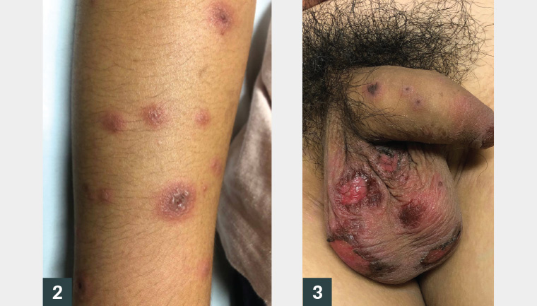 Figure 2. Targetoid lesions on patient’s arm Figure 3. Erosions on scrotum and lesions on penis
