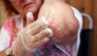 Millions of people around the world use topical steroids to manage their eczema effectively. 