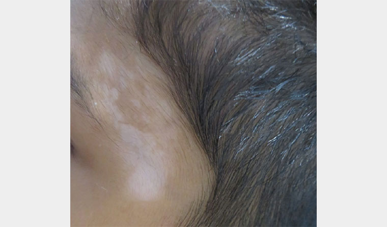 Figure 1. Vitiligo lesions present on the forehead.