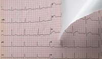 The move to effectively strip GPs of the ability to bill Medicare for the interpretation of ECGs has been taken as a professional slight.