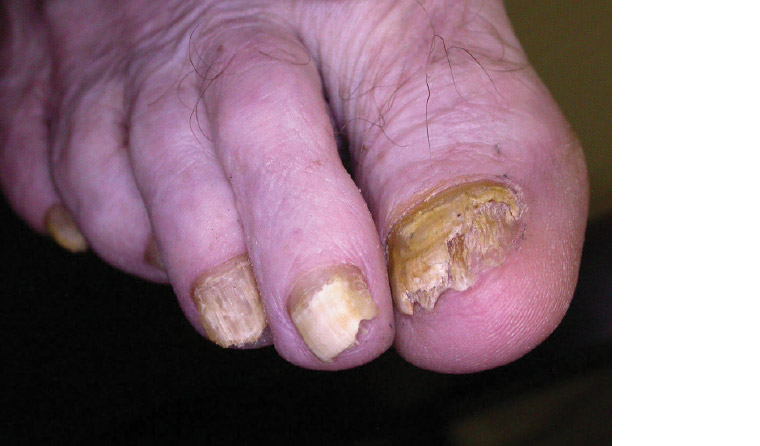 AJGP-10-2019-Clinical-Kovitwanichkanont-Superficial-Fungal-Infections-Fig-3.jpg