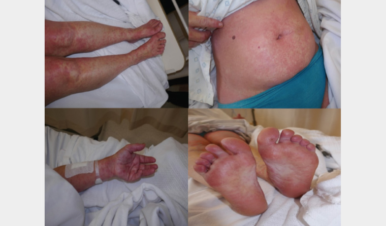 Figure 1. Maculopapular eruption on the limbs, trunk and acral surface