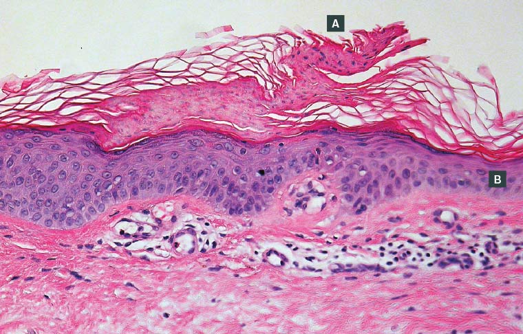 AJGP-11-2019-Clinical-Brand-Pre-Cancerous-Skin-Lesion-Fig-3.jpg