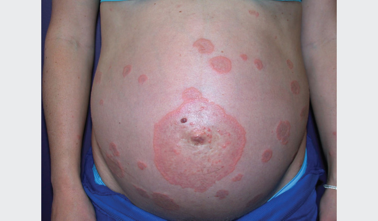 Figure 3. Pemphigoid gestationis: plaques and vesicles that begin on the abdominal wall before spreading, with periumbilical involvement