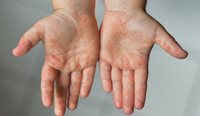 Hand, foot and mouth disease rash
