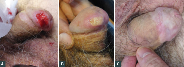 Figure 2. Lesion on the glans penis. A. Immediately post-biopsy; B. Two weeks post-biopsy; C. Four years post-treatment