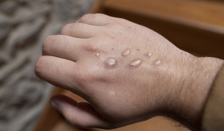 Hand with monkeypox lesions