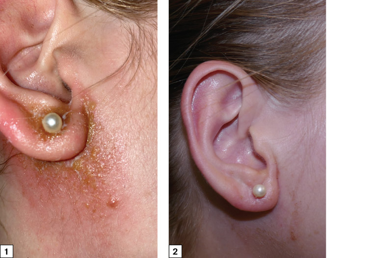 Figure 1. Erythematous vesicular eruption of the right ear lobule and adjacent neck area. Figure 2. Significant improvement