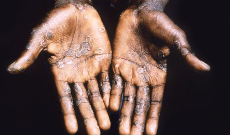 Monkeypox in a traveller returning from Nigeria