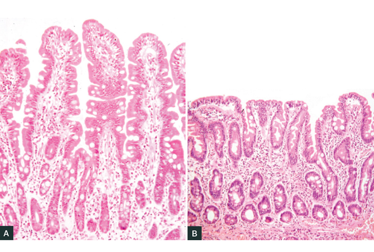 RACGP - Interpreting Tests For Coeliac Disease