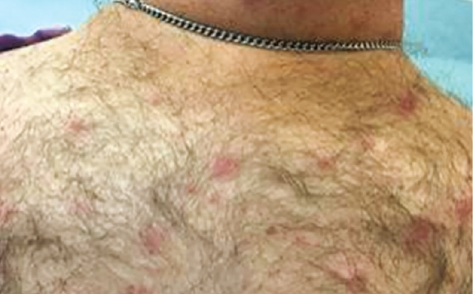 AJGP-06-2018-Clinical-Thomas-Tick-Typhus-Fig-1.jpg