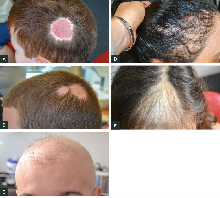 RACGP - Common causes of paediatric alopecia