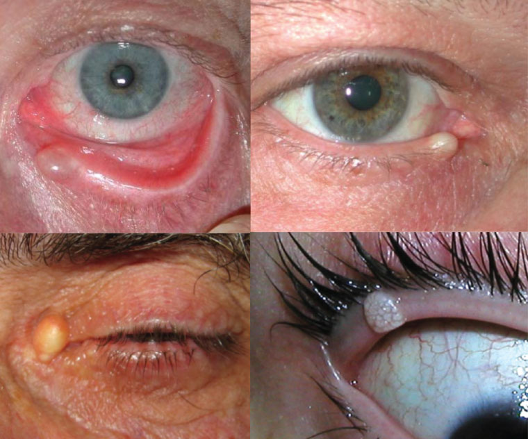 Sun eyelid lesions fig 1