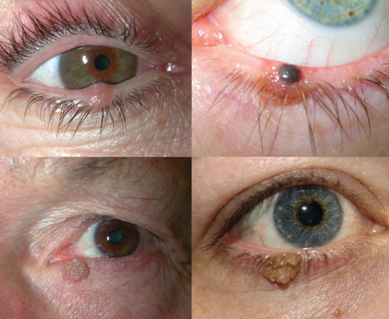 Sun eyelid lesions fig 2