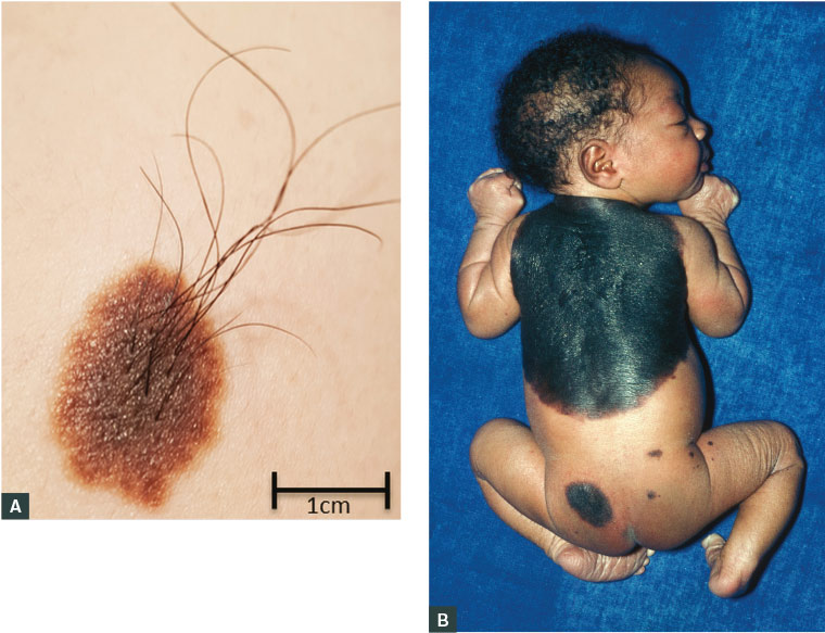 AJGP-08-2019-Clinical-Thompson-Management-Skin-Lesions-Childhood-Fig-1.jpg