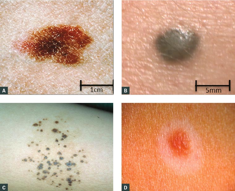 AJGP-08-2019-Clinical-Thompson-Management-Skin-Lesions-Childhood-Fig-2-1.jpg