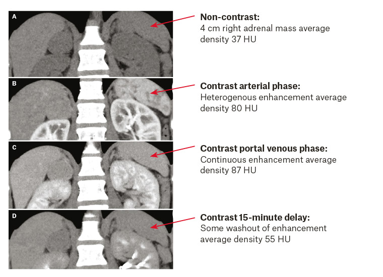 Figure 1. Adrenal computed tomography scan before contrast (A) and after contrast (B–D)