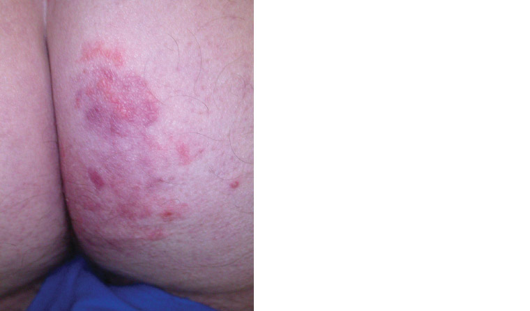 Jock Itch (Tinea Cruris) - Causes, Symptoms, Diagnosis