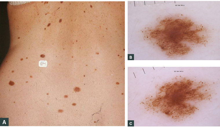AJGP-09-2019-Clinical-Thompson-Pigmented-Skin-Lesions-Pregnancy-Fig-4.jpg