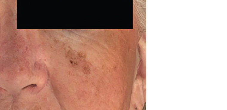AJGP-09-2019-Clinical-Arasu-Skin-Examination-Primary-Care-Fig-8.jpg