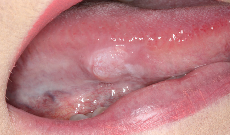Figure 1. A non-homogeneous white keratinised lump on the right lateral border of the tongue