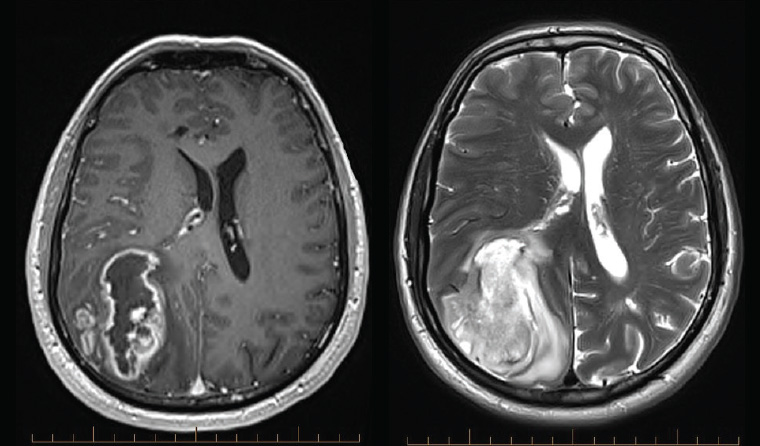 Figure 1. Magnetic resonance imaging showing a typical glioblastoma with central necrosis and peripheral enhancement on contrast-enhanced T1-weighted imaging (left), and surrounding oedema and midline shift on T2-weighted imaging (right)