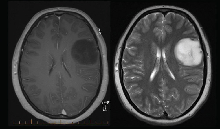 ​Figure 2. Typical low-grade glioma with minimal mass effect