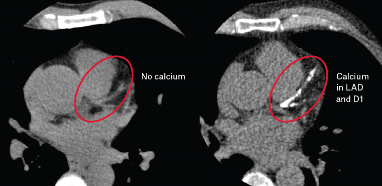 Figure 1. Coronary artery calcium in the left anterior descending (LAD) and first diagonal (D1) arteries