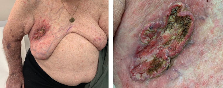 AJGP-08-2020-Clinical-Lobo-Large-Fungating-Skin-Lesion-Fig-1.jpg