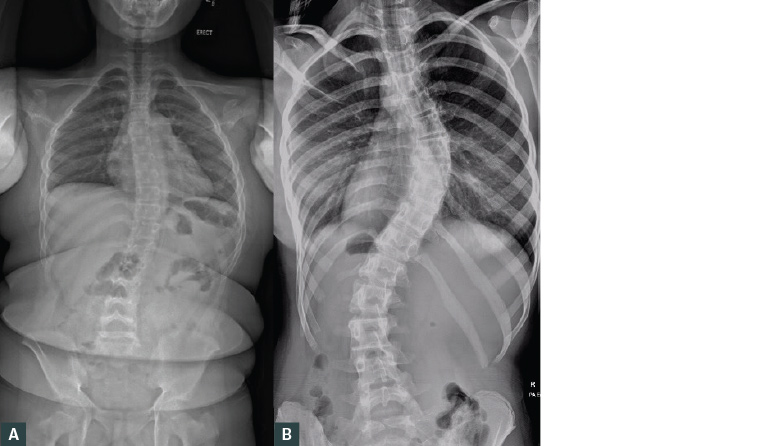 RACGP - Paediatric Scoliosis