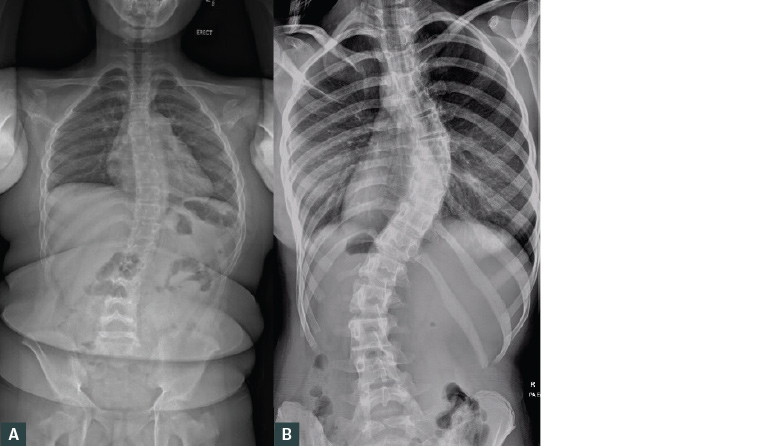 Figure 2. Erect plain posteroanterior radiographs of the spine