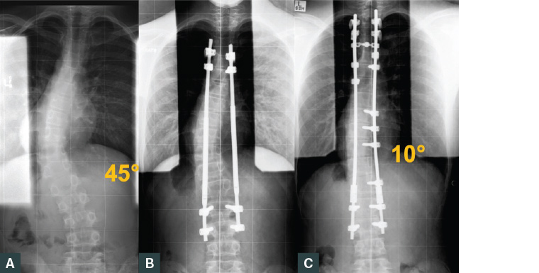 ​Figure 4. Erect plain posteroanterior radiographs of the spine of a patient with Arnold Chiari malformation type 1 and syrinx and atypical scoliosis treated with growing rods