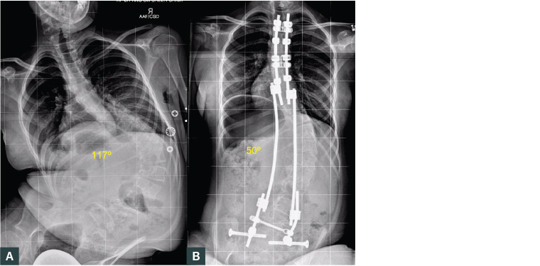 Figure 6. Sitting plain posteroanterior radiographs of the spine of a female aged 10 years with neuromuscular scoliosis (pelvic obliquity 27°) treated with bipolar posterior instrumentation.