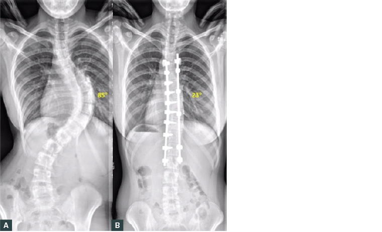 RACGP - Paediatric Scoliosis