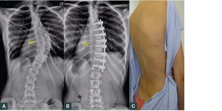 Figure 8. Female aged 16 years with idiopathic scoliosis treated with thoracoscopic instrumented correction and fusion.