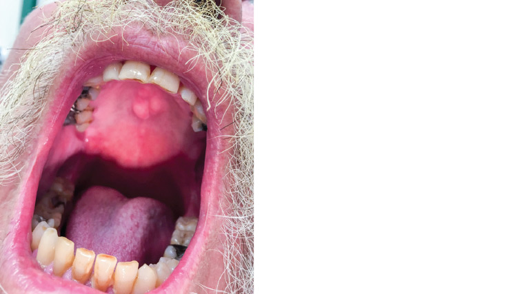 Figure 1. Clinical appearance of the lump on the hard palate (midline)
