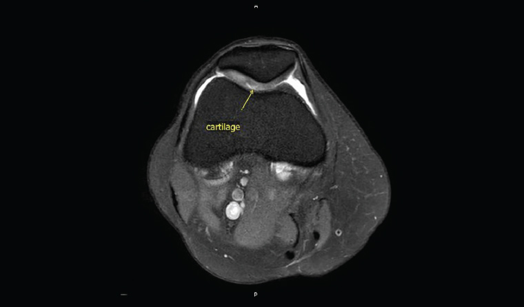 Figure 3. A small focus of chondromalacia can be seen clearly on a magnetic resonance imaging scan.