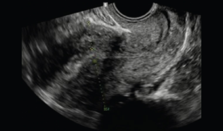​Figure 1. Pelvic ultrasound with features suggestive of adenomyosis: heterogeneous myometrium and ‘venetian blind’ artefact.