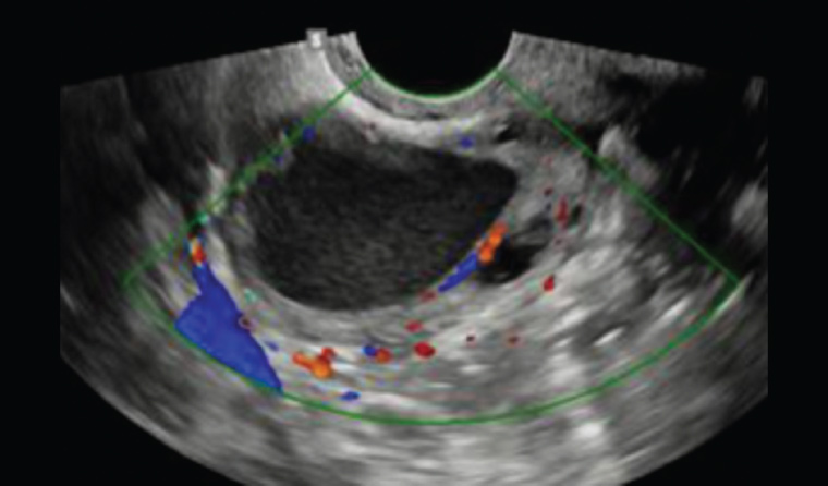Figure 2. Pelvic ultrasound showing typical ‘ground glass’ appearance of an endometrioma.