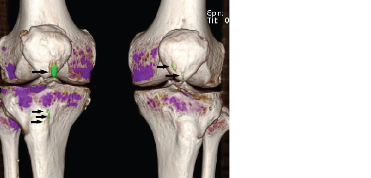 Figure 11. Volume-rendered dual-energy computed tomography scan. Urate deposits (gouty tophi) are shown in green (arrows). Other views show these to lie in the patella tendons bilaterally.