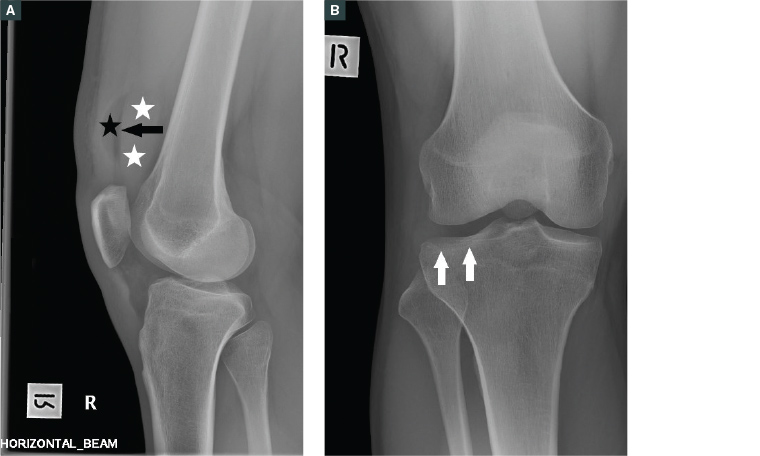 Figure 2. a. Lipohaemarthrosis in the suprapatellar recess with fat (black star) and fluid (white stars) producing a fluid level (black arrow). Note that this image is taken with a horizontal beam; b. Frontal X-ray shows a relatively subtle lateral tibial plateau fracture (white arrows) that might be overlooked if the lipohaemarthrosis was not recognised.