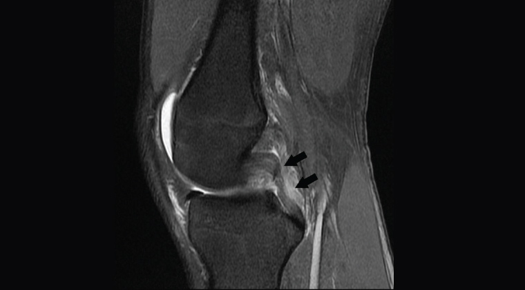Figure 4. Sagittal proton density fat-saturated image showing ruptured posterior cruciate ligament (black arrows).