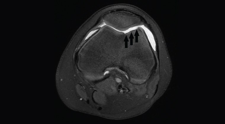 Figure 6. Axial proton density fat-saturated image showing a large defect in the articular cartilage of the femoral condyle from previous patellar dislocation (black arrows).